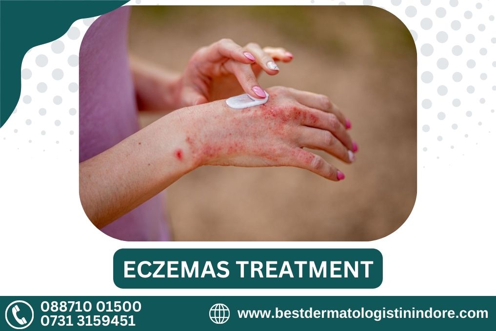 Best Skin Specialist for Eczema Treatment in Indore